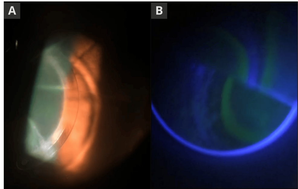 Challenges in Glaucoma Management in High Myopia After Refractive Surgery: A Case Report