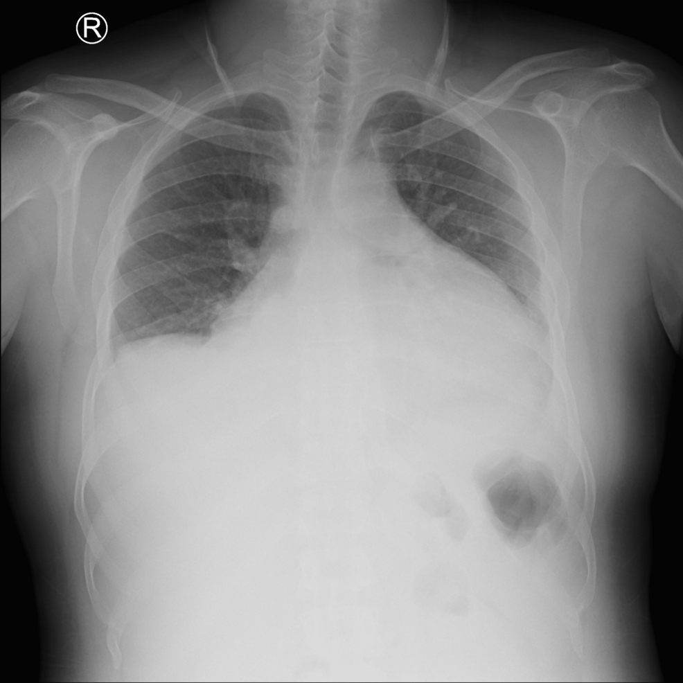 Right Atrial Angiosarcoma Presenting With Cardiac Tamponade, Hemorrhagic Pericardial Effusion, and Pulmonary Embolism: A Case Report