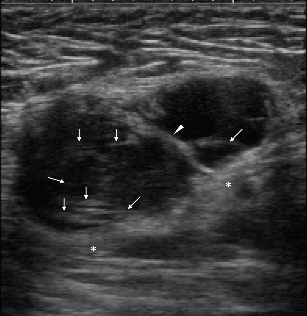 Myxofibrosarcomas Have Extremely Low Internal Echoes: A Case Report
