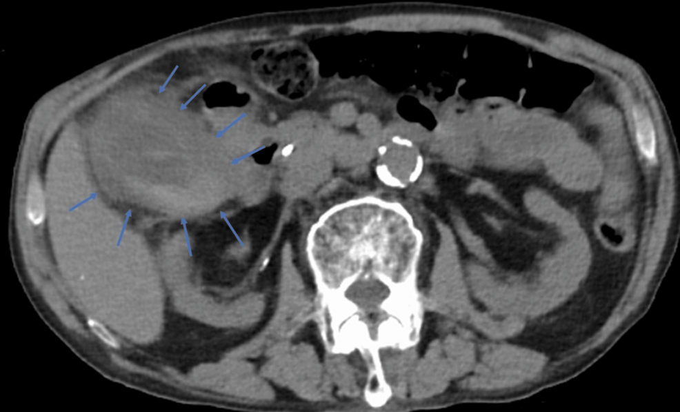 Successful Management of Recurrent Cholecystitis Four Years After Endoscopic Gallbladder Stenting (EGBS) Placement Using Internal and External Fistula Drainage