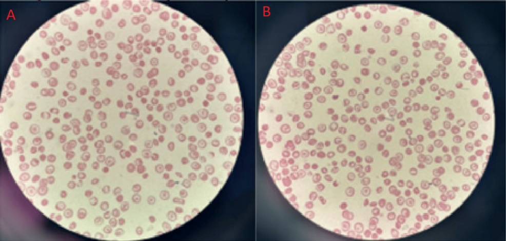 Severe Pain Phenotype in Hemoglobin C (HbC)/Beta-Zero (β⁰) Thalassemia Without Hemoglobin S (HbS): A Clinical and Diagnostic Challenge