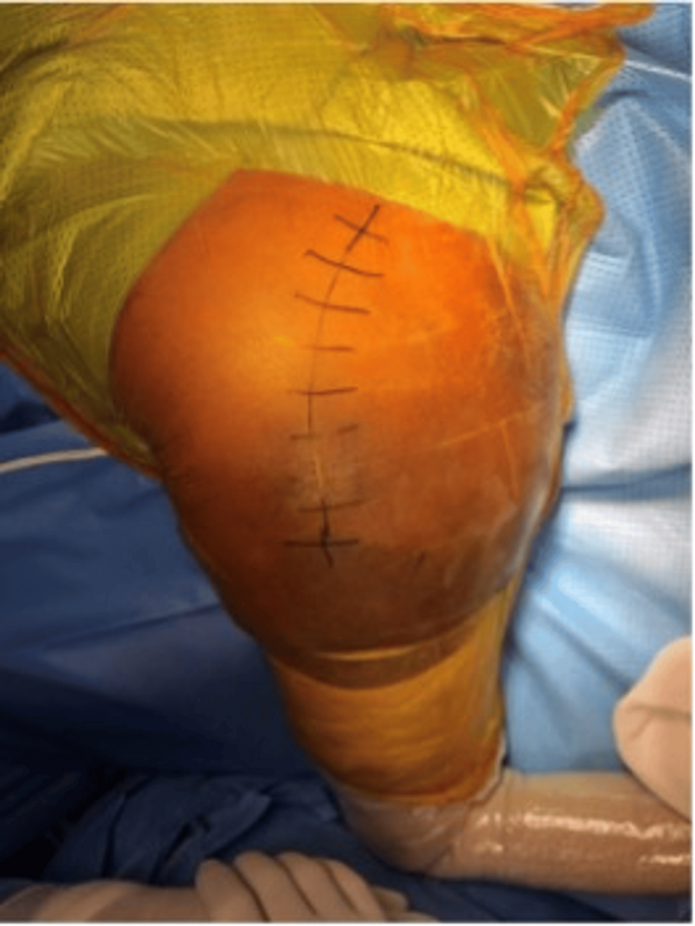 Hemiarthroplasty as a Viable Option for Unstable Intertrochanteric Femur Fractures in the Elderly: A Functional Outcome Analysis