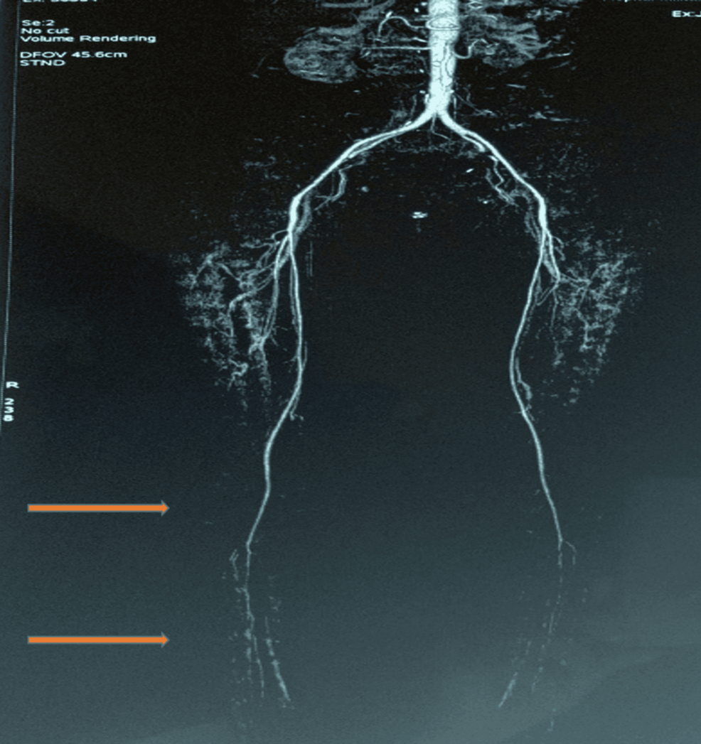 An Under-Recognized Manifestation of Systemic Sclerosis: Macrovascular Peripheral Arterial Disease