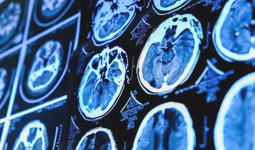 Enlarged brain drainage may signal early Alzheimer’s