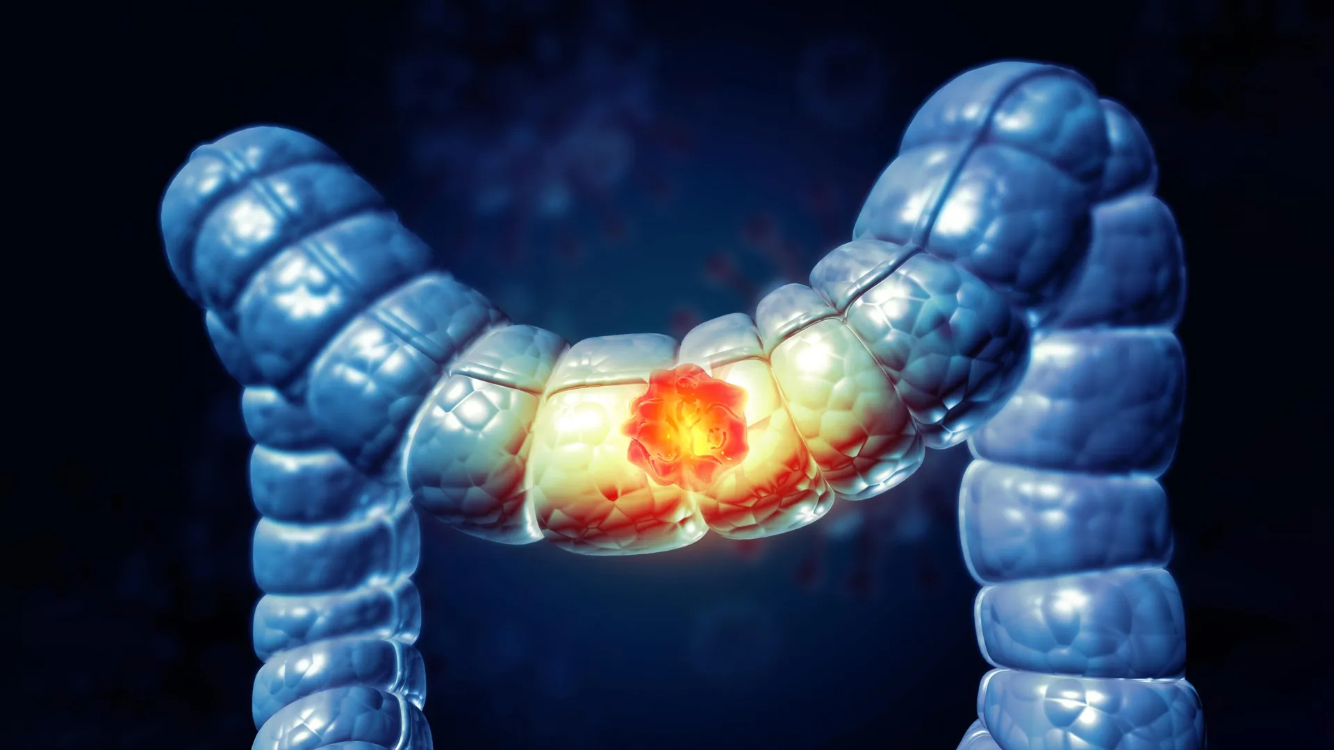 Why colorectal cancer breaks the immune system’s rules