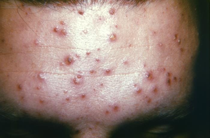 Chickenpox outbreak reported at Trinidad and Tobago prison