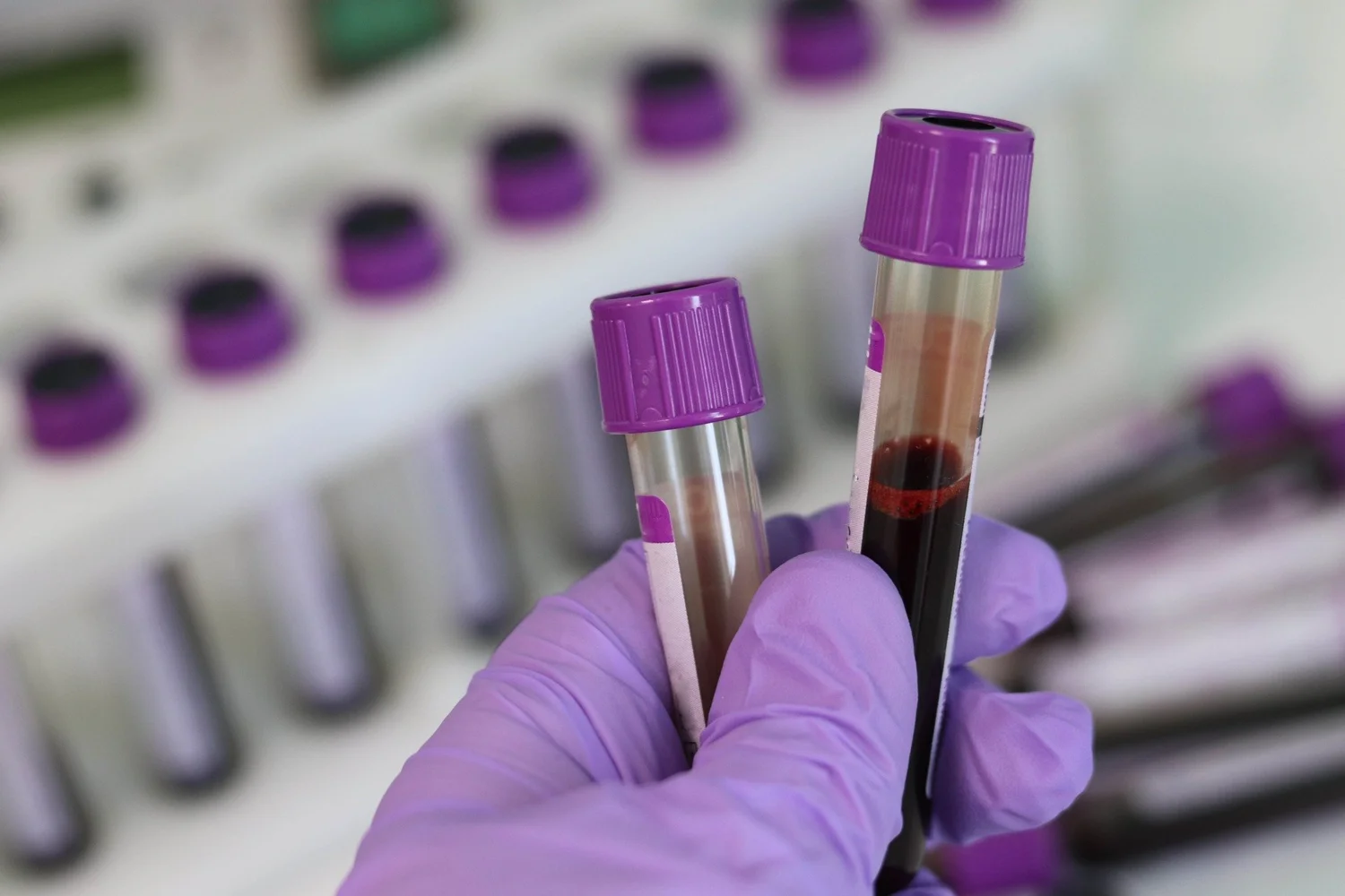Blood Test Aids Cancer Detection in Vague Symptom Cases