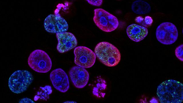 AI Tool Predicts Metastatic Risk Across Cancers