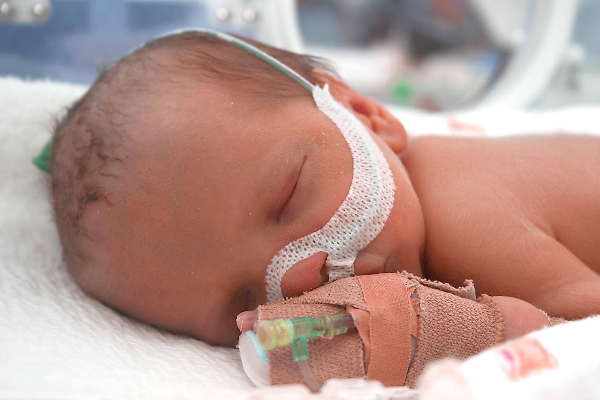 Sleep Breathing Disruptions in Newborns with Severe Spina Bifida
