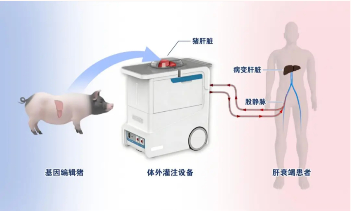 Chinese scientists achieve world’s first treatment of liver failure patient using ex vivo perfusion with a gene-edited pig liver: report