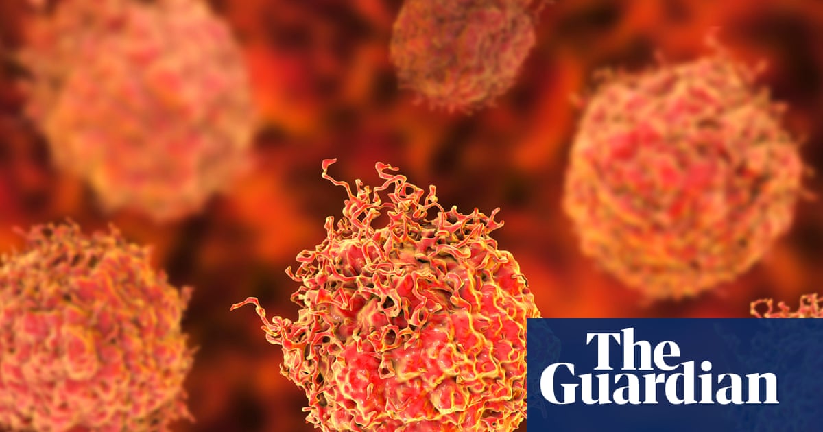 Researchers praise ‘stunning’ results of new prostate cancer treatment | Prostate cancer