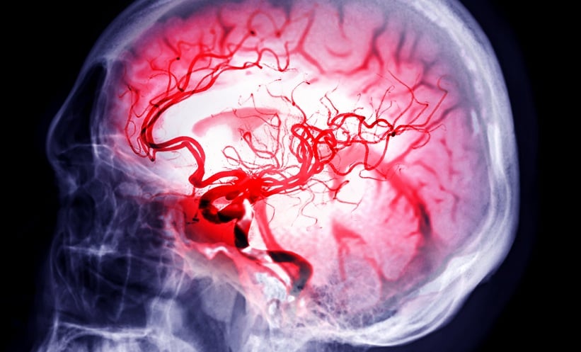 GLP-1RAs Linked to Reduced Stroke Risk
