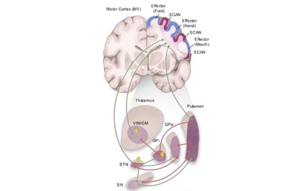 Brain network dysfunction central to Parkinson’s disease identified