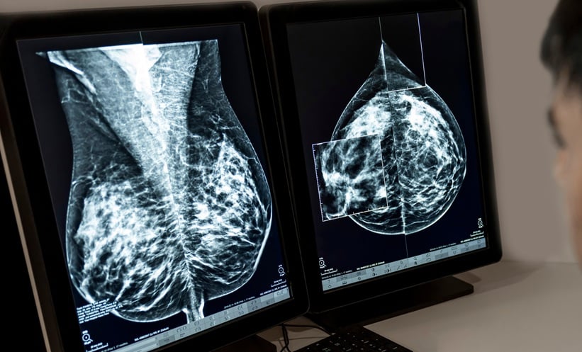 Imaging in Survivors of Breast Cancer