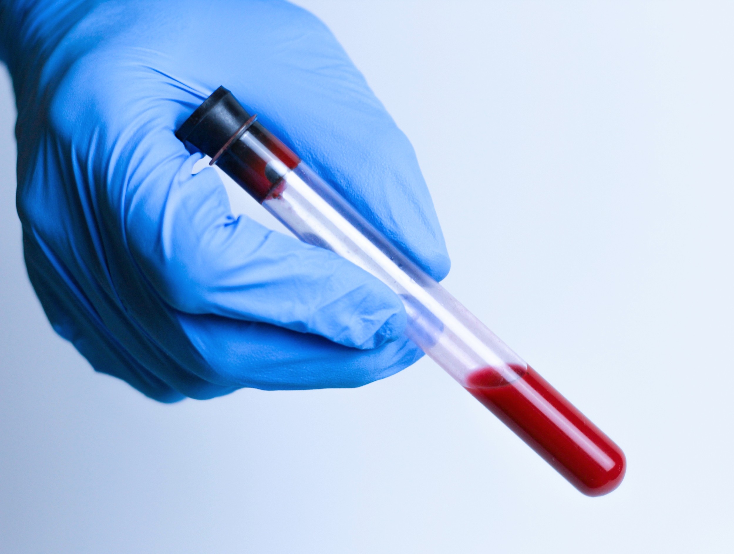 Simple blood test predicts when Alzheimer’s symptoms will begin