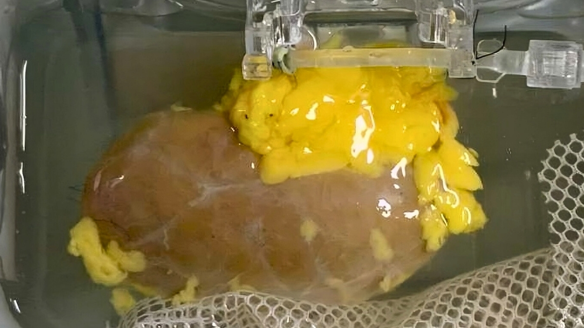 Scientists Created a ‘Universal’ Kidney To Match Any Blood Type : ScienceAlert