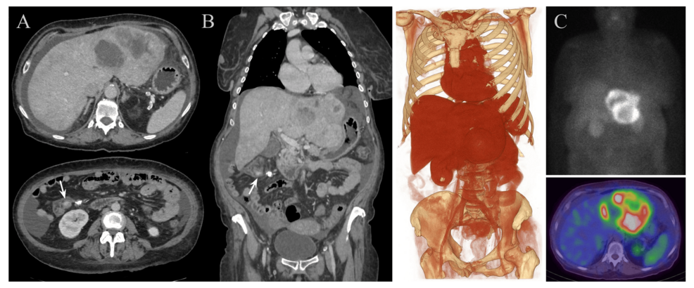 Multivalvular Cardiac Involvement from Giant Hepatic Metastases of an Ileal Neuroendocrine Tumor