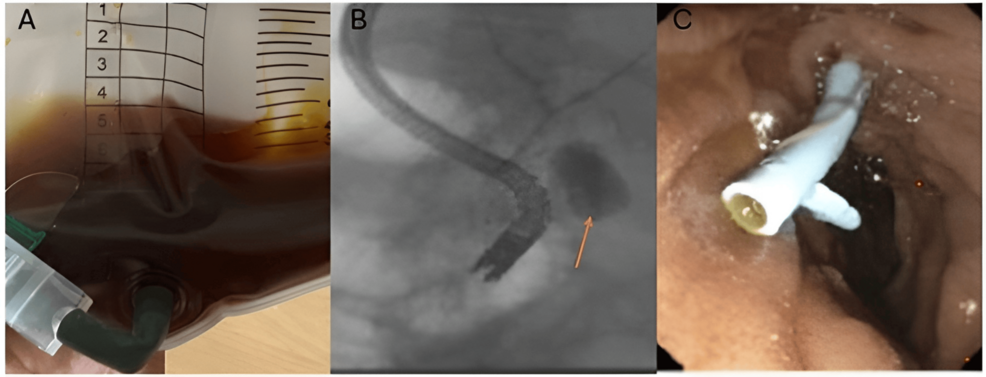 Post-cholecystectomy Choleperitoneum Due to Cystic Duct Stump Leak: A Case Report Emphasizing Diagnostic Challenges and Multidisciplinary Management