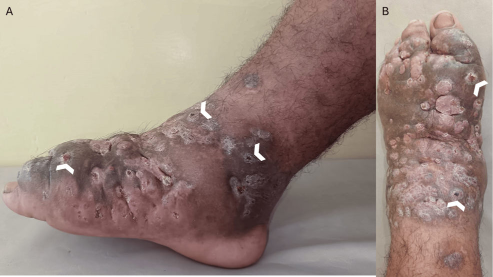 Actinomycetoma Due to Nocardia brasiliensis: Recognition in Primary Care