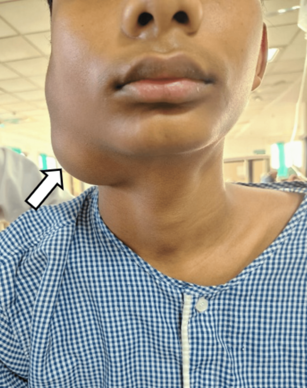 Venolymphatic Malformation Presenting as a Low-Flow Vascular Anomaly: A Case Report