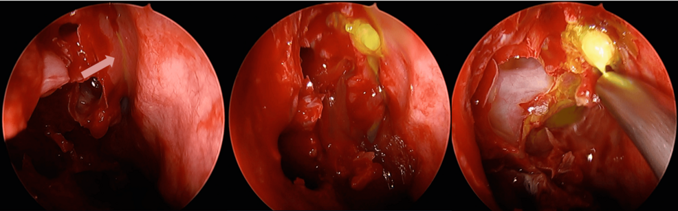 Intrathecal Fluorescein in the Surgical Management of Spontaneous Cerebrospinal Fluid Leaks: A Case Report