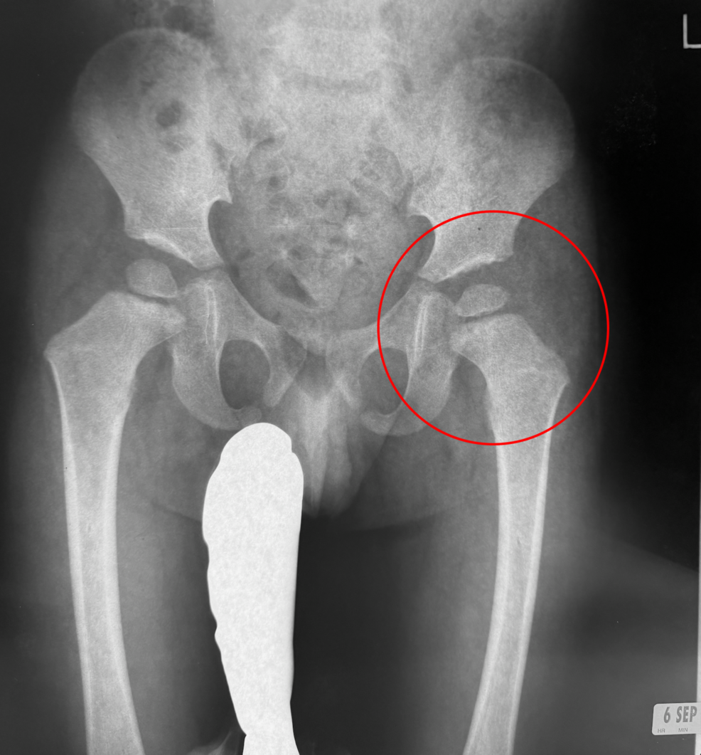 Severe Radiographic Legg-Calvé-Perthes Disease With Favorable Long-Term Functional Outcomes Following Conservative Management: A Case Report