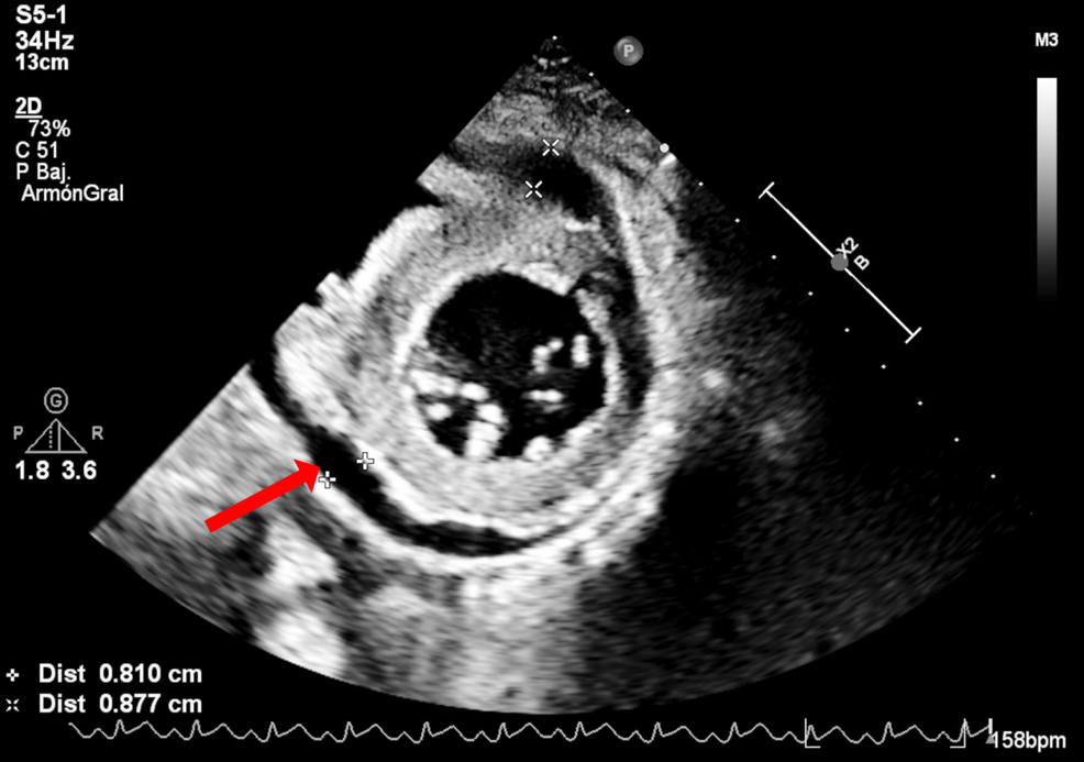 Fulminant Influenza B Myocarditis in an Adolescent Requiring Venoarterial Extracorporeal Membrane Oxygenation (VA-ECMO): Complete Recovery at a Pediatric Cardiac Referral Center in Mexico