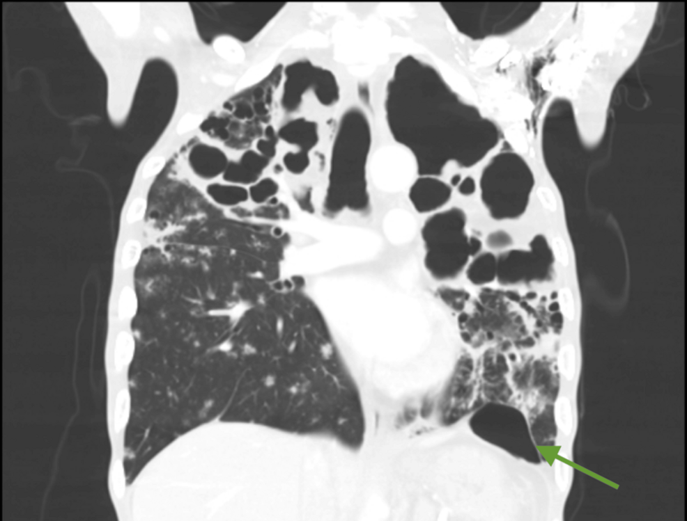A Case Report of General Anesthesia for Abdominal Surgery in Severe Cavitary Tuberculosis: Strategies to Minimize Barotrauma