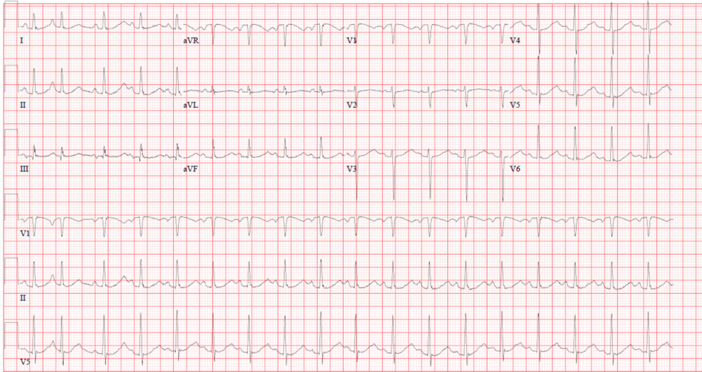 Stress-Induced Takotsubo Cardiomyopathy Identified by Unique Nuclear Perfusion Pattern