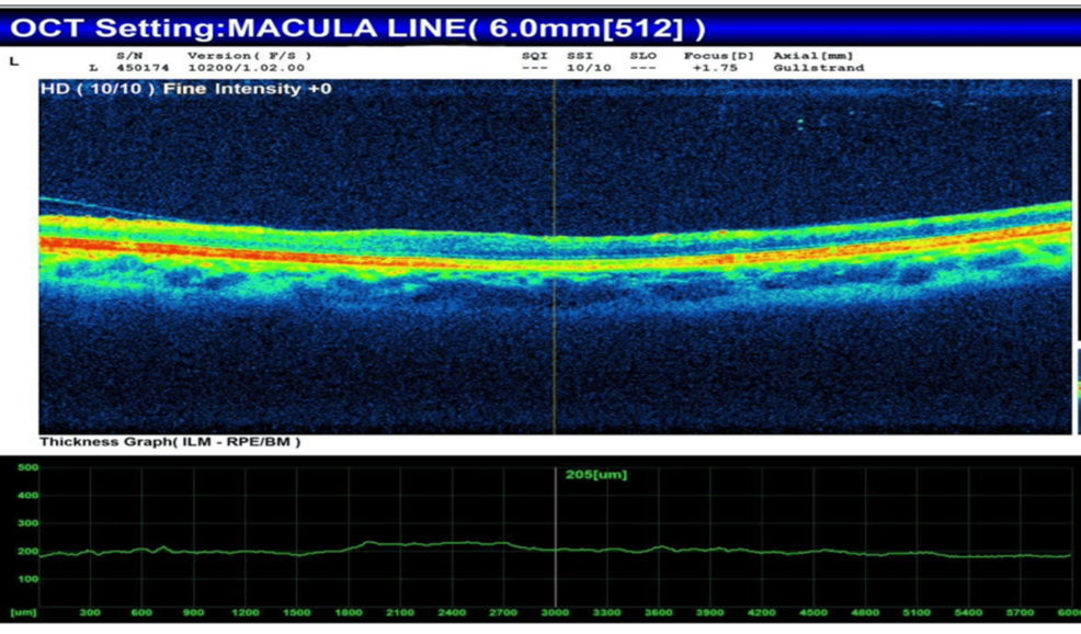 Isolated Cone Dystrophy With Secondary Macular Involvement Mimicking Vascular Insult and Optic Atrophy: A Case Report