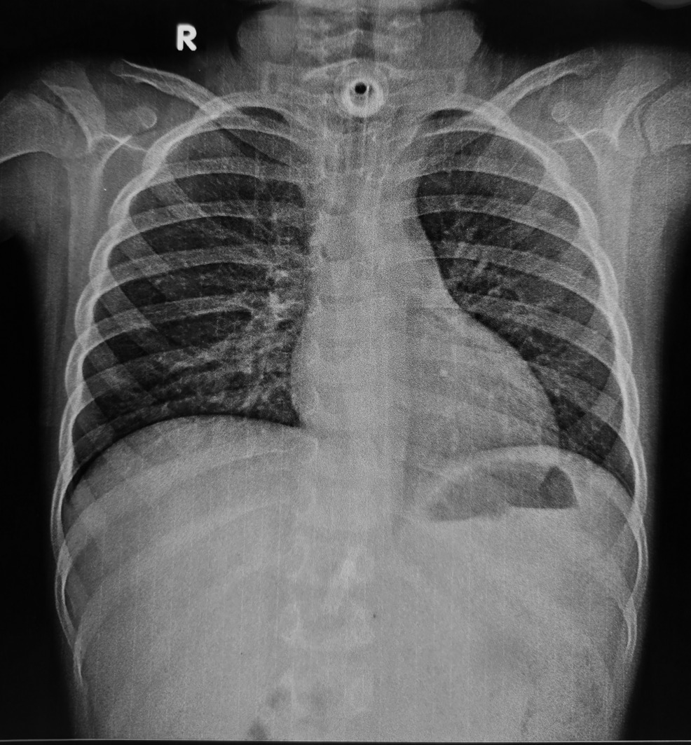 Iatrogenic Pneumothorax Complicating Airway Management of Post-diphtheritic Tracheal Stenosis in a Pediatric Patient: A Case Report