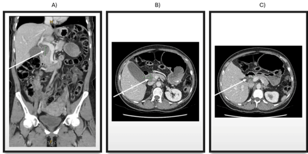 Surgical Management of Pancreatic Head Arteriovenous Malformation: A Case Report