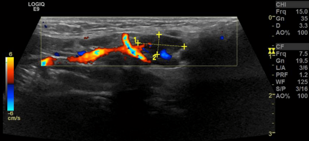 Kikuchi Disease With Marfanoid Features in a Background of Fever of Unknown Origin