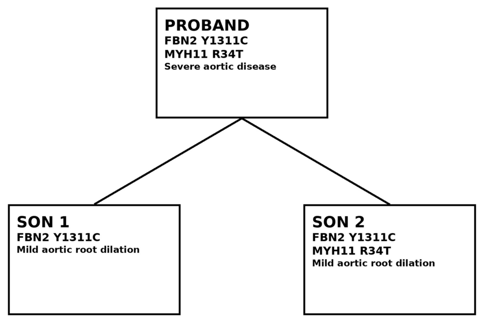 A Familial Thoracic Aortic and Arterial Aneurysm Syndrome Associated With FBN2 (Y1311C) and MYH11 (R34T) Variants: A Multigenerational Case Report