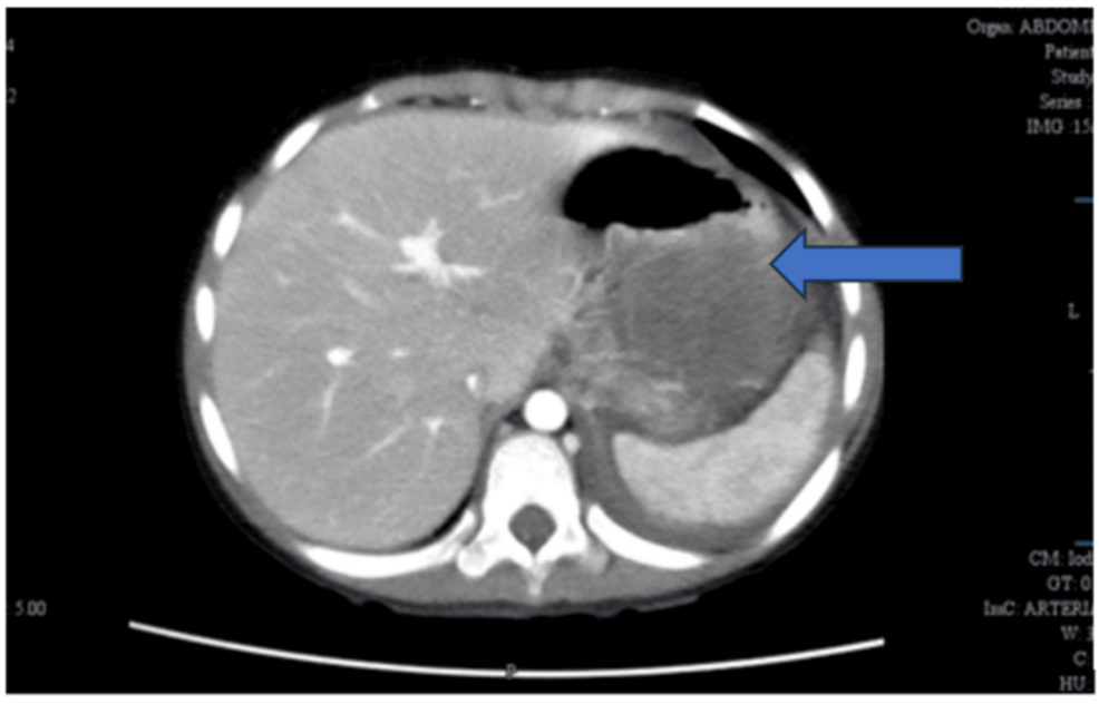 Pediatric Solid Pseudopapillary Neoplasm With Aberrant CD31 Expression: A Potential Diagnostic Pitfall