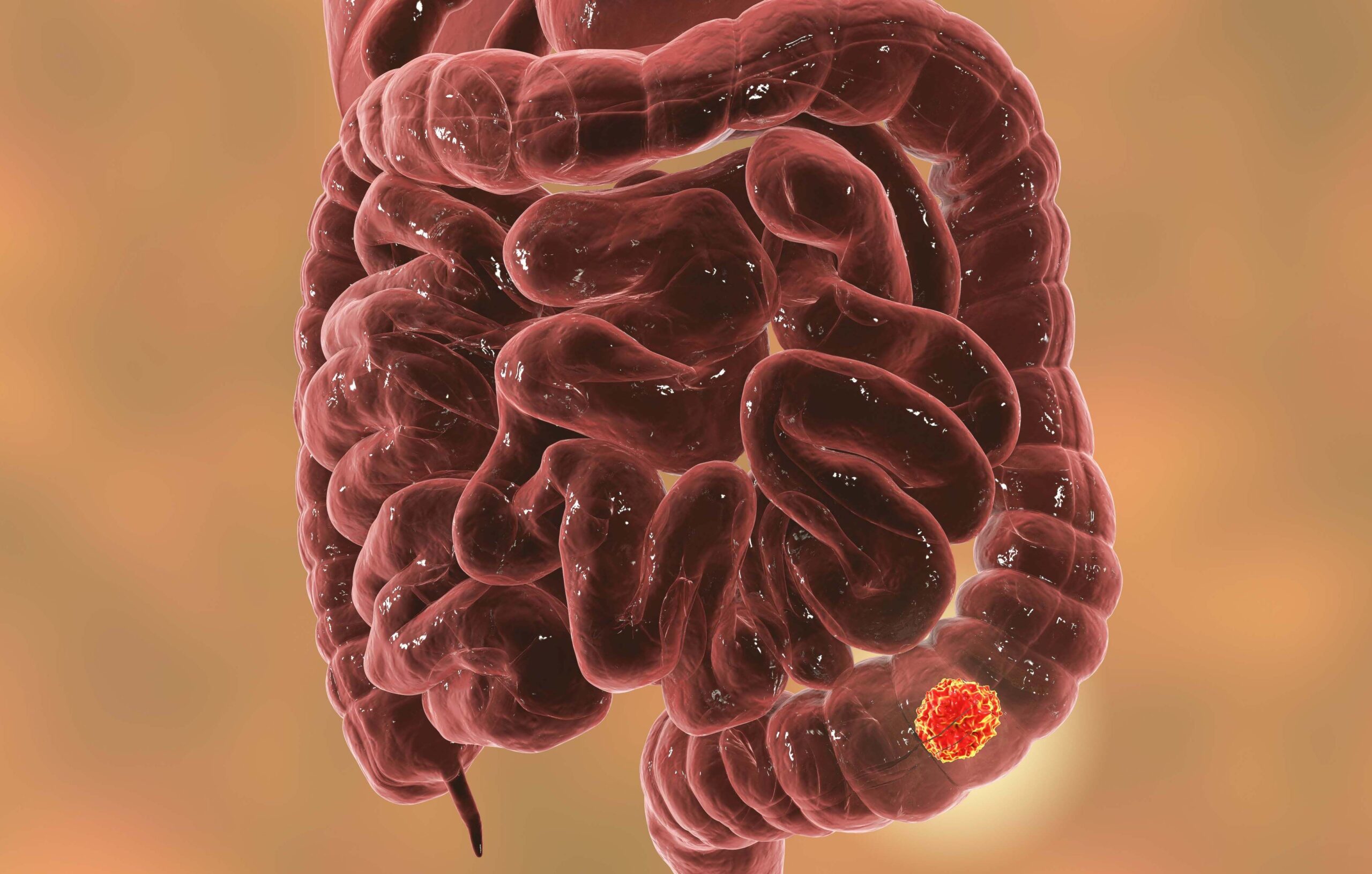 Adjuvant Chemo Noninferor at 3 Months Vs 6 Months in Stage II/III CRC