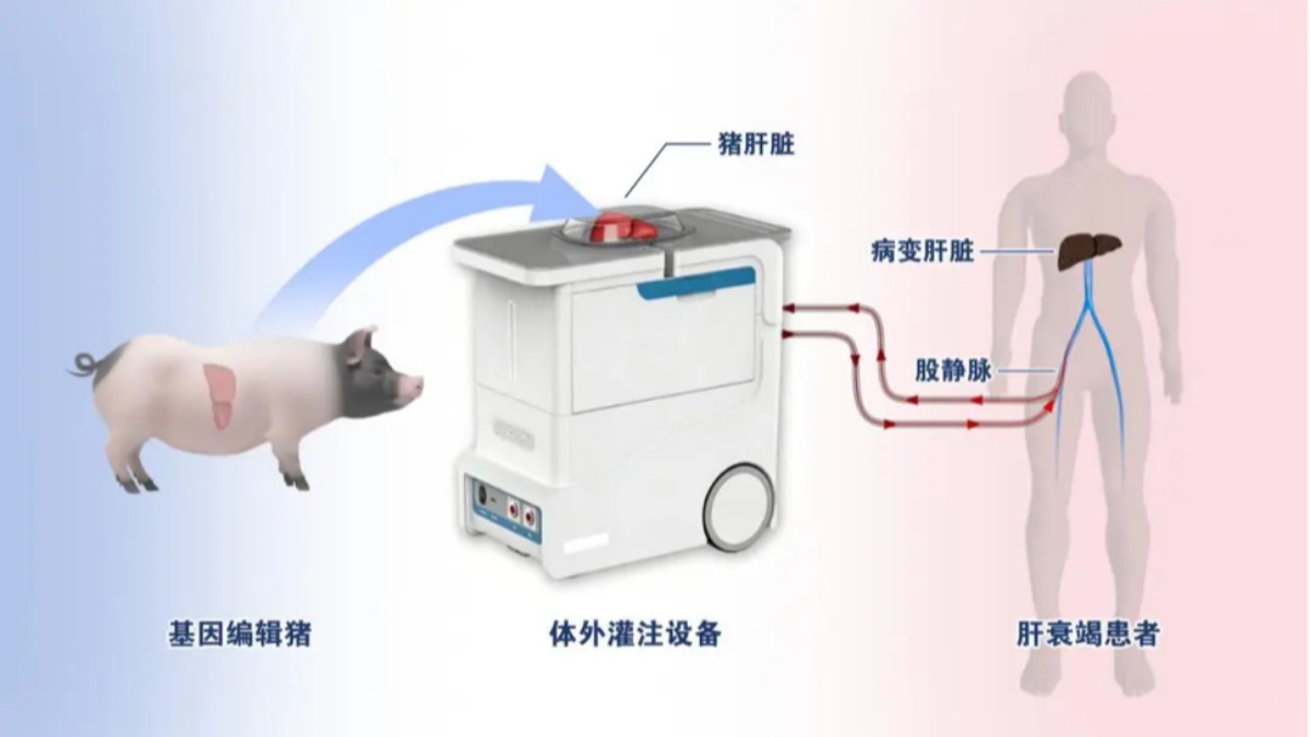 Chinese scientists achieve world’s first treatment of liver failure patient using ex vivo perfusion with a gene-edited pig liver: report