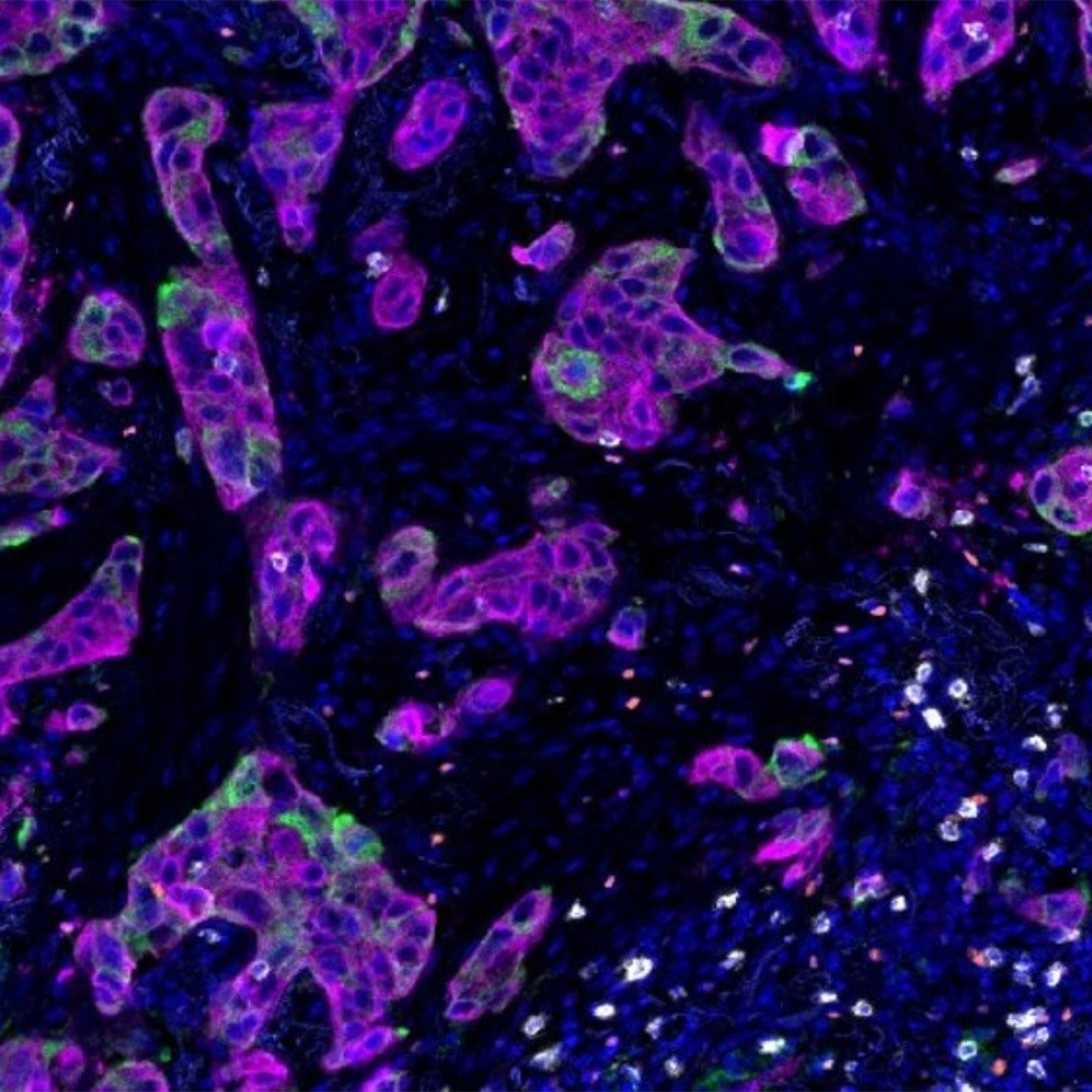 Type of KRAS mutation may guide more effective cancer treatments: Newsroom