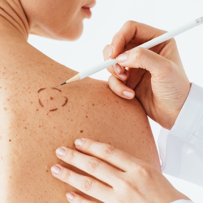 Antibiotics and Immunotherapy in Melanoma