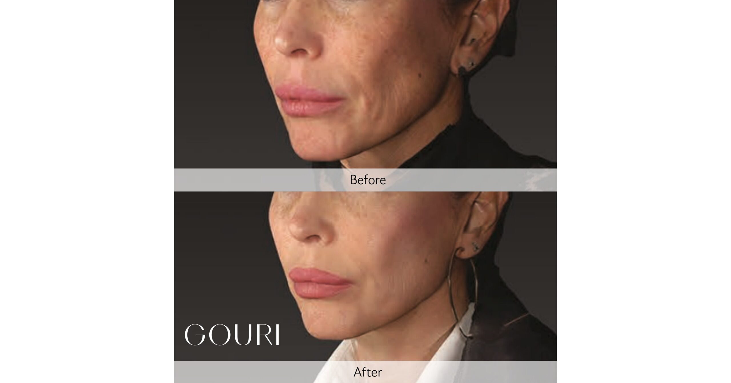 The Expansion of the Structural Skin Laxity Improvement and Liquid Type PCL Collagen Stimulator Market