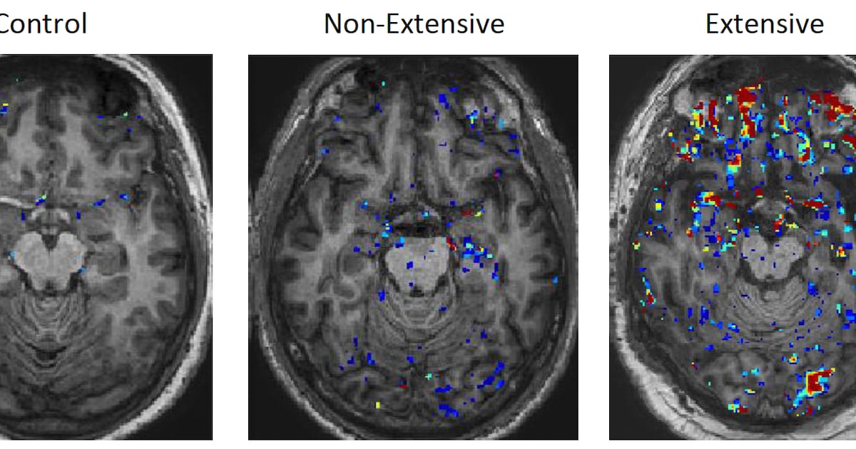 ‘Leaky’ brain barrier a key link between head trauma and brain disease, study finds – The Irish Times