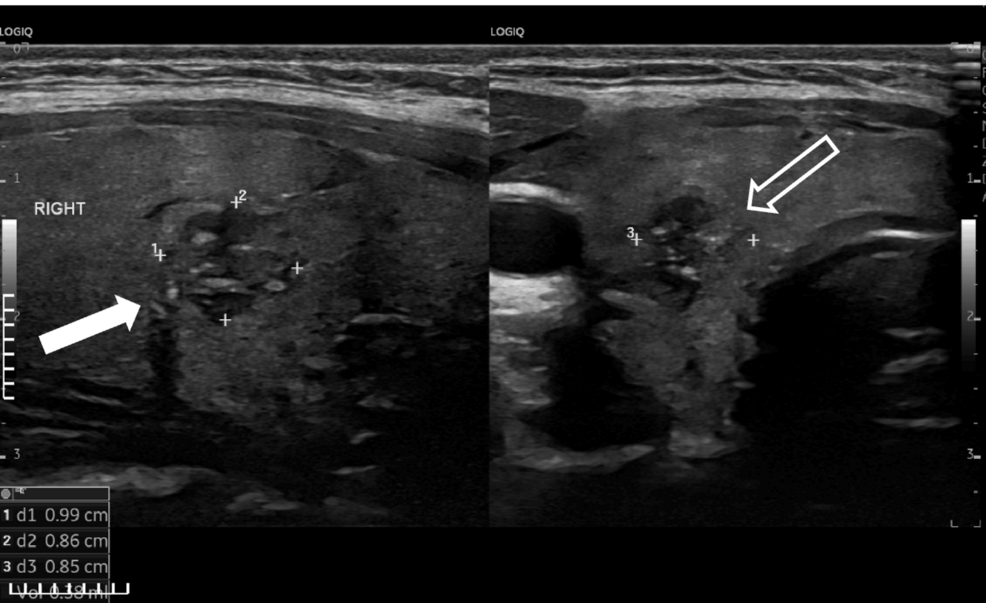 Papillary Thyroid Carcinoma in a Pediatric Patient With Graves’ Disease: A Case Report and Literature Review