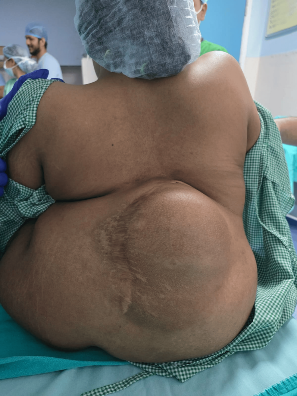 Remifentanil-Based Monitored Anesthesia Care in a Paraplegic Patient With Severe Kyphoscoliosis, Non-palpable Spinal Landmarks, and Coagulation Abnormality Undergoing Ischiorectal Abscess Drainage: A Case Report