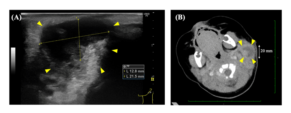 Excessive Inflammatory Response to Bacterial Lymphadenitis in an Infant With A Family History of Recurrent Lymph Node Swelling: A Case Report