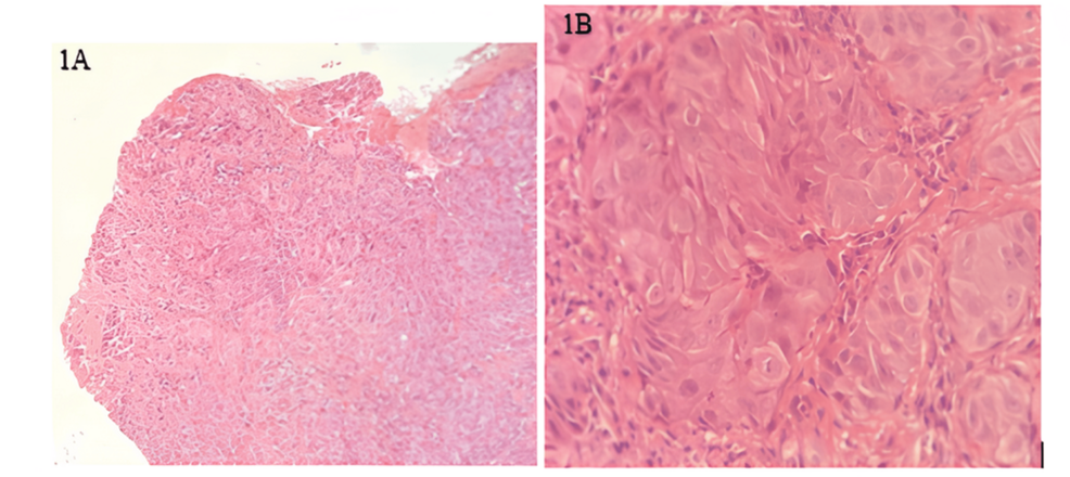 Cracking the Chameleon: Uncommon Presentations and Pitfalls of Oral Squamous Cell Carcinoma
