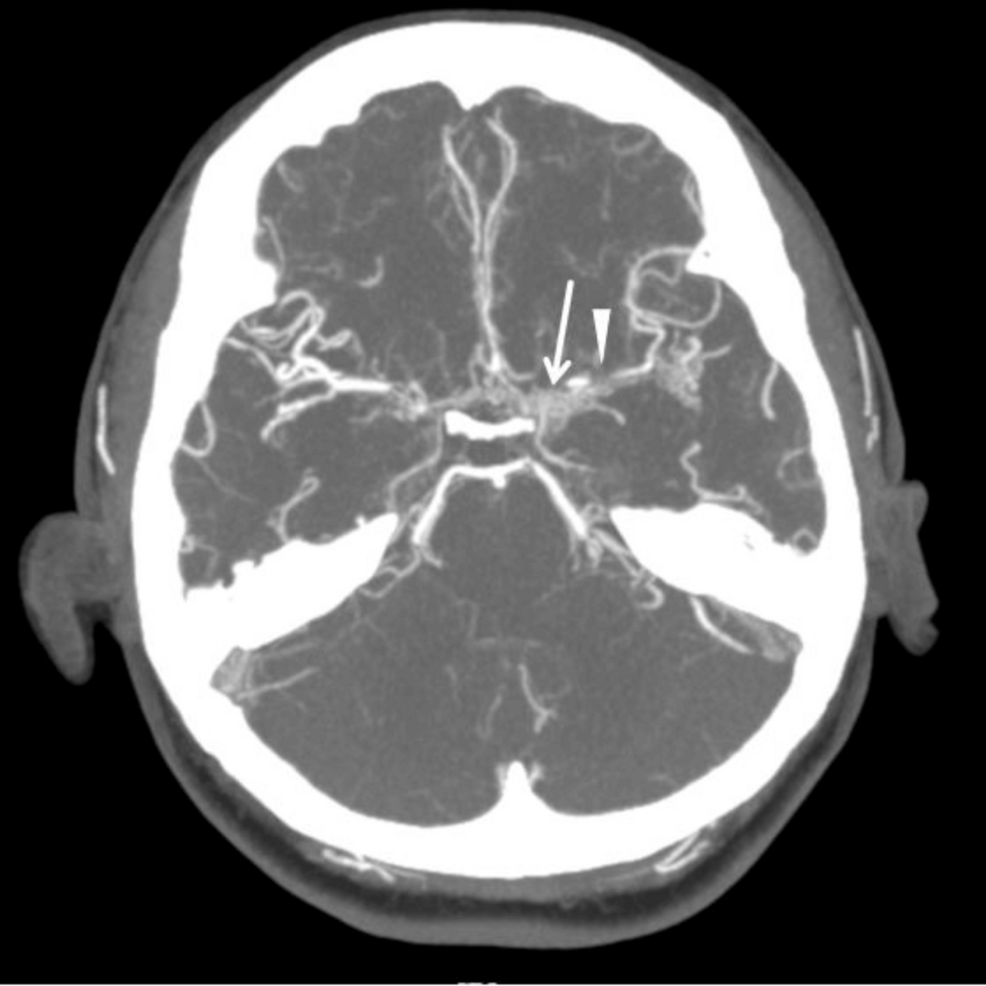 Recurrent Ischemic Events in Adult Moyamoya Disease: A Case Report of Persistent Symptoms Despite Encephaloduroarteriosynangiosis (EDAS) Surgery
