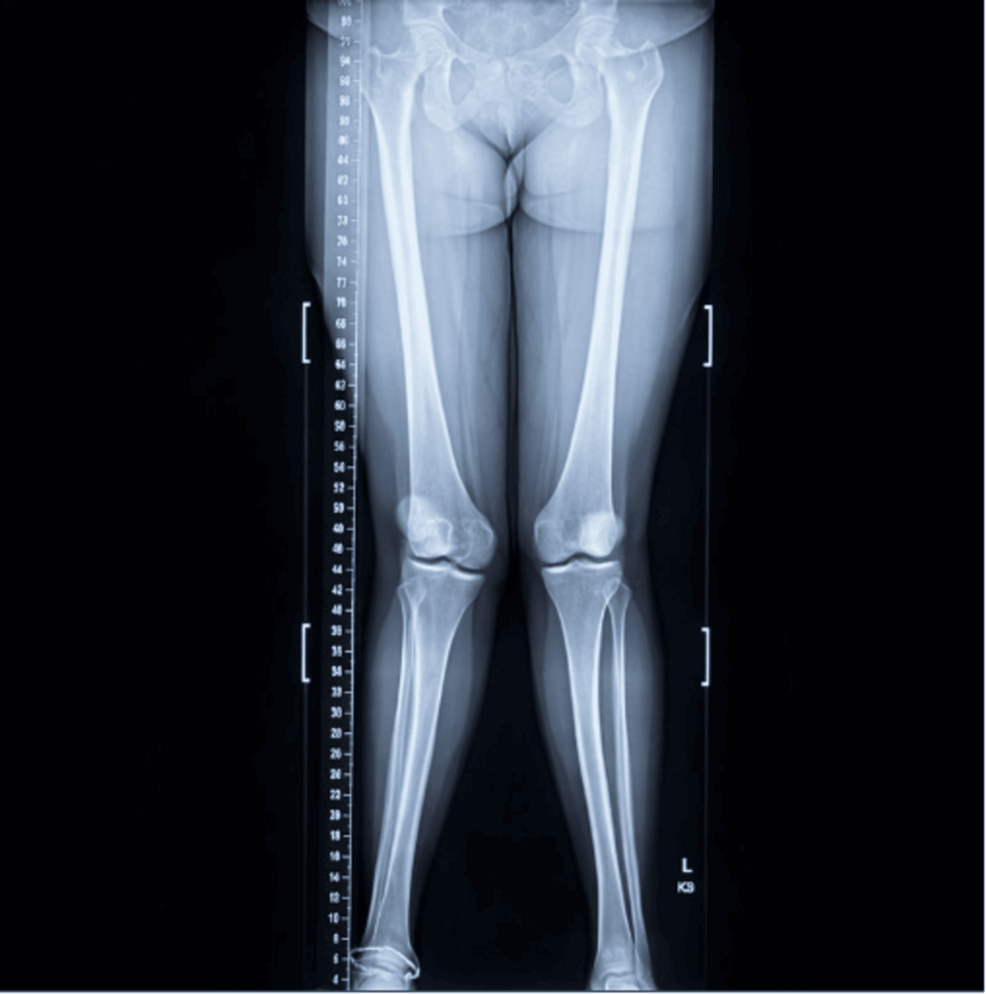 Improvement of Chronic Lateral Knee Pain Through Osteopathic Manipulative Treatment Targeting Anterior Fibular Head Somatic Dysfunction: A Case Report