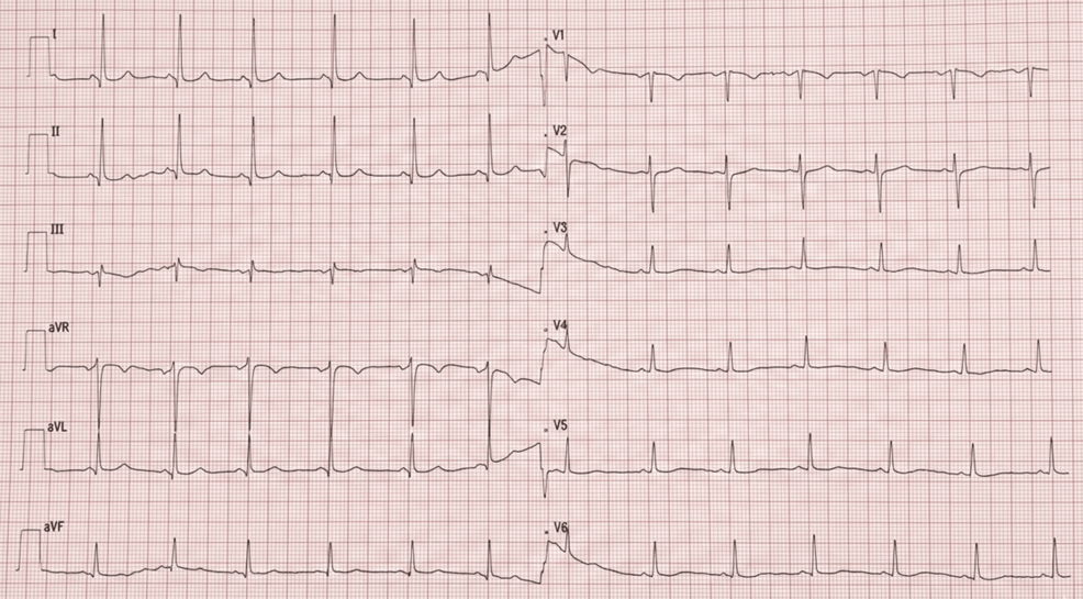 Management Dilemma of an Asymptomatic Carotid Web in a High-Risk Patient: A Case Report