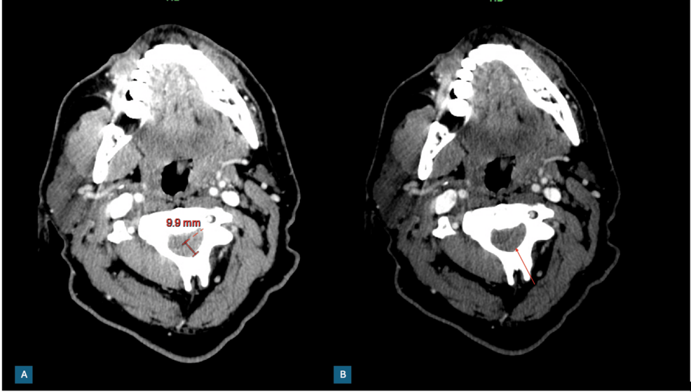 Idiopathic Spontaneous Cervical Epidural Hematoma: A Sudden Neurological Catastrophe