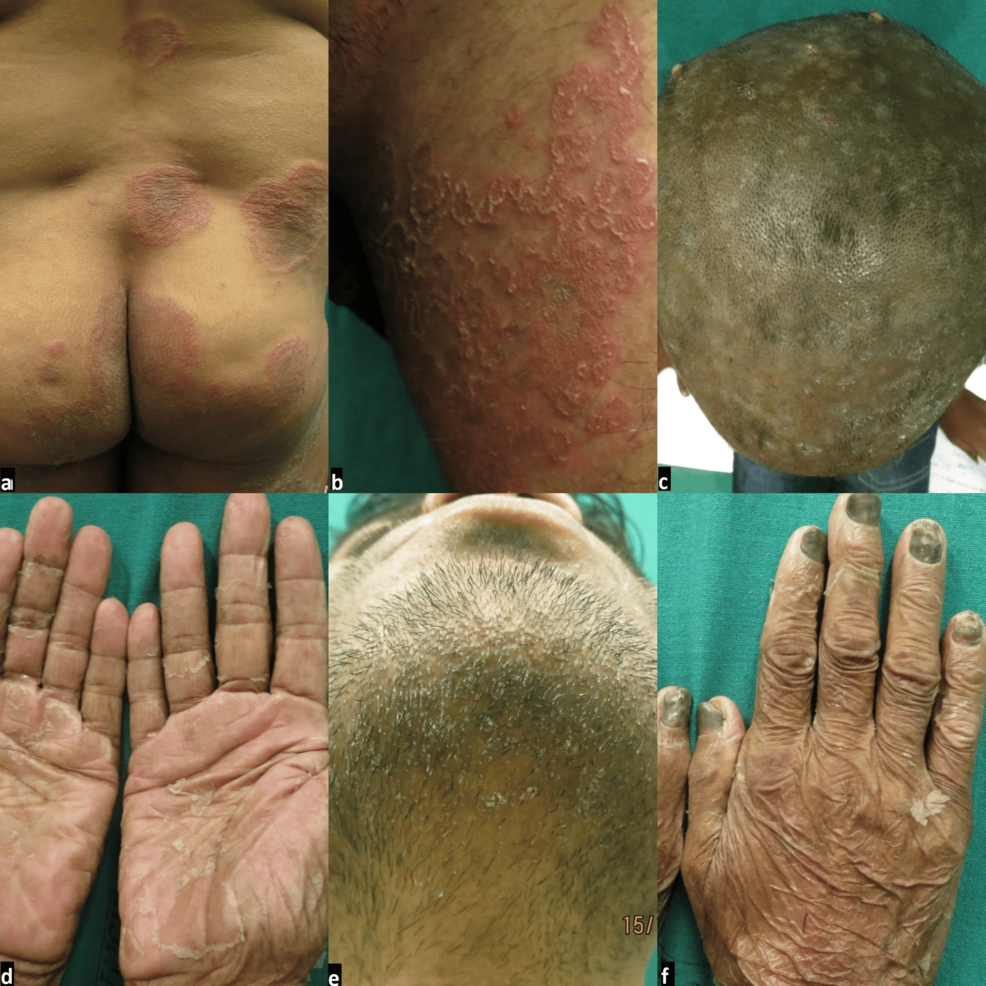 Clinical, Epidemiological, and Mycological Characteristics of Dermatophyte Infections: A Cross-Sectional Study From a Tertiary Care Hospital